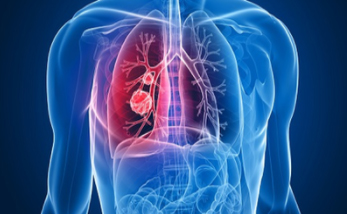 重磅！“長壽蛋白”表達水平提升能夠大幅減少肺部衰老細胞，幫助治療特發性肺纖維化